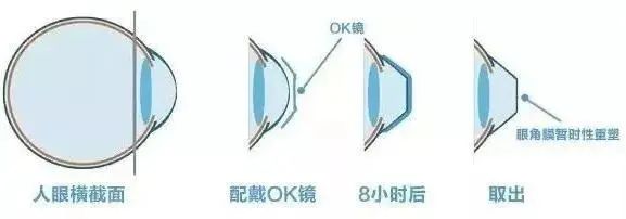 進口醫(yī)療器械角膜塑形鏡如何報關(guān)？