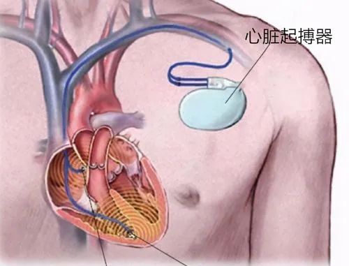 政策解讀 | 進(jìn)口心臟起搏器有哪些監(jiān)管要求？